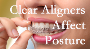 Clear aligners influence posture which McHenry chiropractic helps.