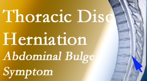 OrthoIllinois Chiropractic treats thoracic disc herniation that for some patients prompts abdominal pain.