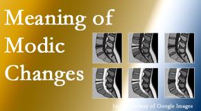 OrthoIllinois Chiropractic sees many back pain and neck pain patients who bring their MRIs with them to the office. Modic changes are often seen. 