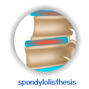 picture of McHenry spondylolisthesis